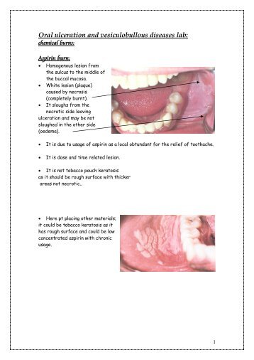 Oral Ulceration and Vesiculobullous Diseases (Lab). - my toothy