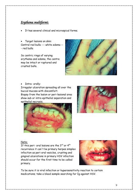 Oral Ulceration and Vesiculobullous Diseases (Lab). - my toothy