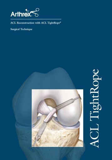 ACL Reconstruction with ACL Tightrope - Sumisan SA