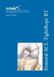 ACL TightRope RT for Femoral Fixation - Canmed Ortopedi Medikal