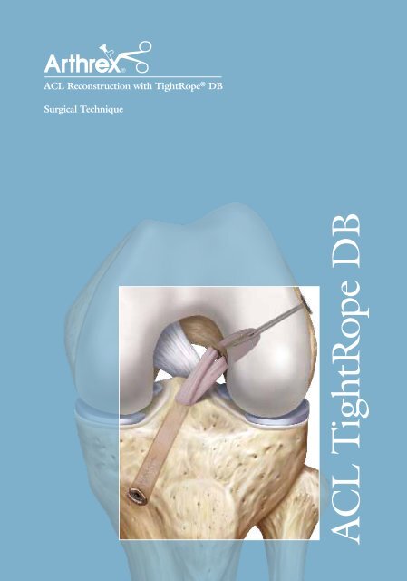 ACL Reconstruction with TightRope® DB - Arthrex