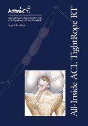 All-Inside® ACL Reconstruction with ACL TightRope ... - Sumisan SA