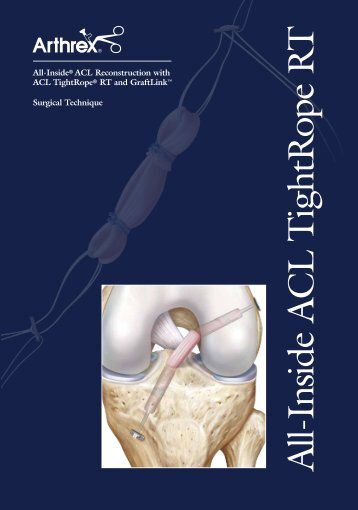 All-Inside® ACL Reconstruction with ACL TightRope ... - Sumisan SA