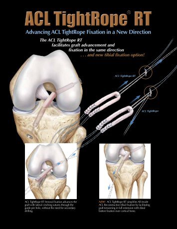 ACL TightRope® RT - Arthrex