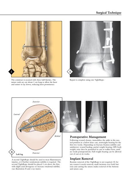 TightRope™ Syndesmosis Fixation - DrStorm