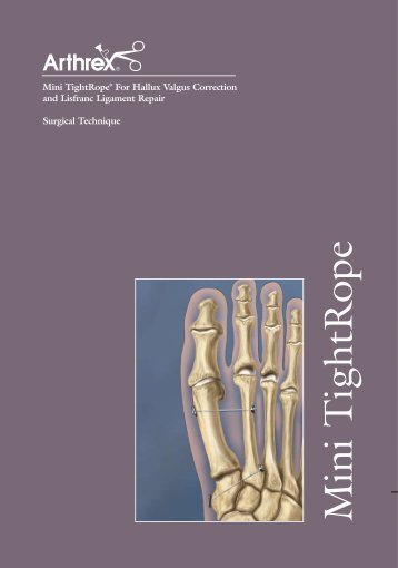 Mini TightRope® For Hallux Valgus Correction and Lisfranc ...