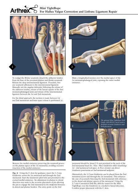 Mini TightRope® For Hallux Valgus Correction and Lisfranc ...