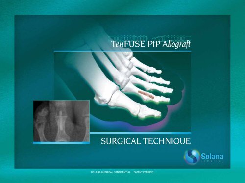 PIP Surgical Technique Brochure (Mobile) - Solana Surgical