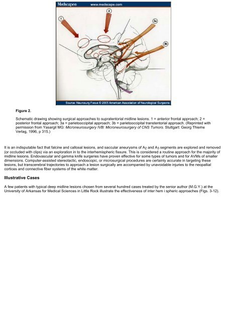 Surgical Anatomy of Supratentorial Midline Lesions