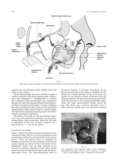 Buccinator myomucosal flap: clinical results and review of anatomy ...