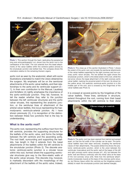 The surgical anatomy of the aortic root - Multimedia Manual Cardio ...