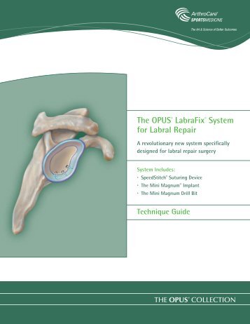 The OPUS® LabraFix® System for Labral Repair - ArthroCare ...