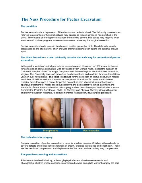 The Nuss Procedure For Pectus Excavatum