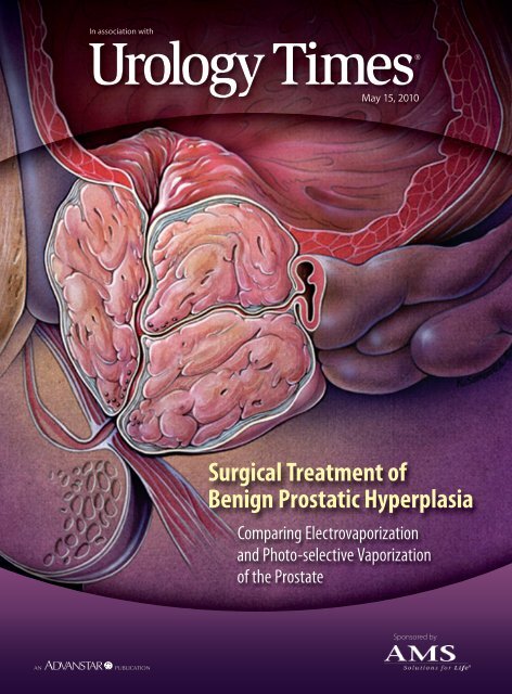 Surgical Treatment Of Benign Prostatic Hyperplasia - Greenlight