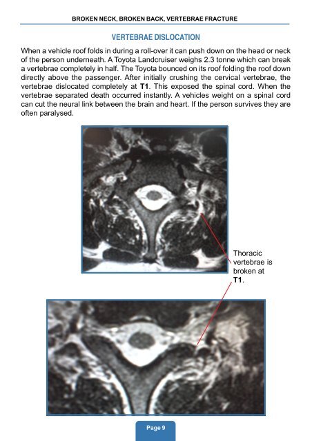 broken neck, broken back, vertebrae fracture