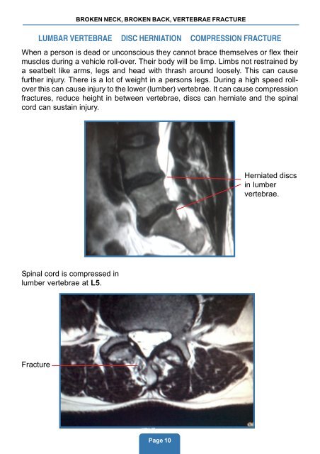 broken neck, broken back, vertebrae fracture