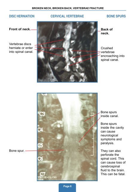 broken neck, broken back, vertebrae fracture