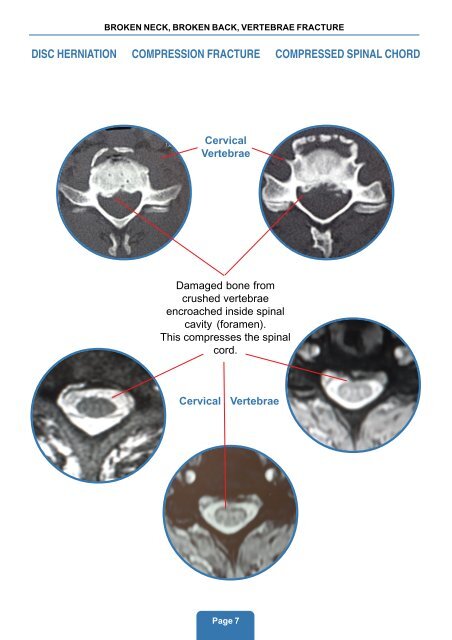 broken neck, broken back, vertebrae fracture