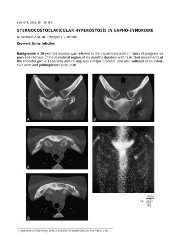 sternocostoclavicular hyperostosis in sapho-syndrome - rbrs