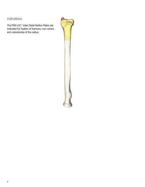 Volar Distal Radius Locking Plate - Wheeless' Textbook of ...