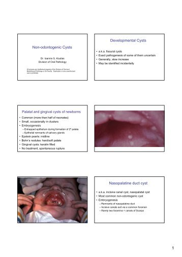 Non-odontogenic Cysts Developmental Cysts Nasopalatine duct cyst