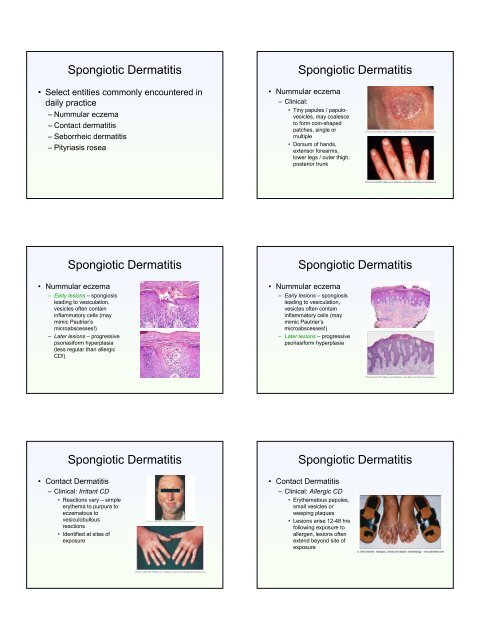 Spongiosis Spongiosis Dermatitis with 'Spongiosis' Dermatitis with ...