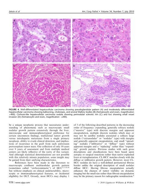 Diffuse Cirrhosis-like Hepatocellular Carcinoma - Rush University ...