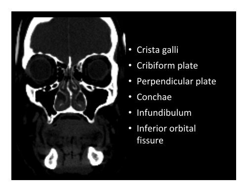 Skull and Dura - Department of Medical Imaging - University of Toronto