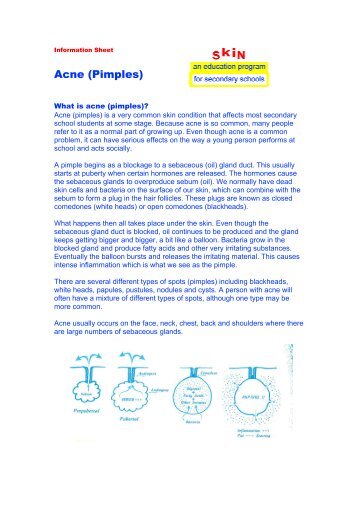 Acne (Pimples) - Department of Dermatology, St. Vincent's Hospital ...