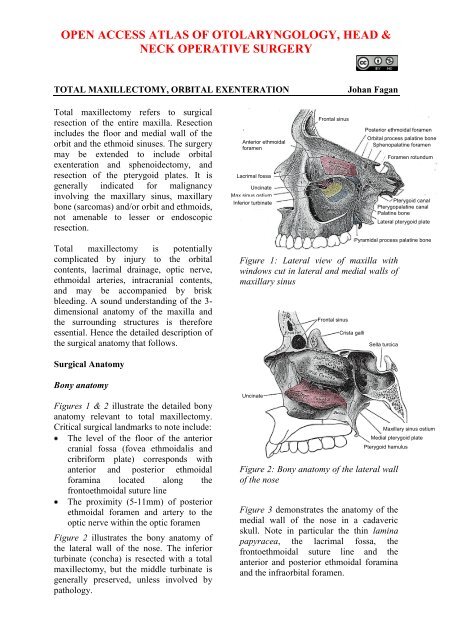 Total maxillectomy and Orbital Exenteration - Vula - University of ...