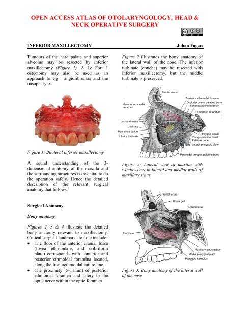 Inferior maxillectomy - Vula - University of Cape Town