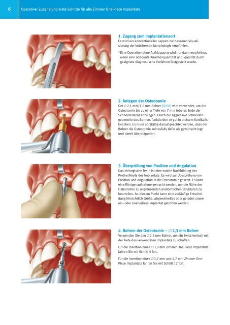 Zimmer® One-Piece Implantatsystem - Zimmer Dental