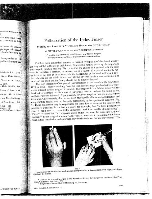 Pollicization of the Index Finger