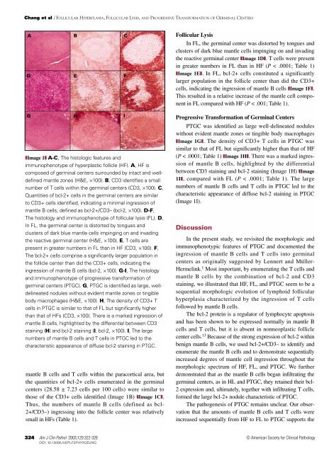 Follicular Hyperplasia, Follicular Lysis, and Progressive - American ...