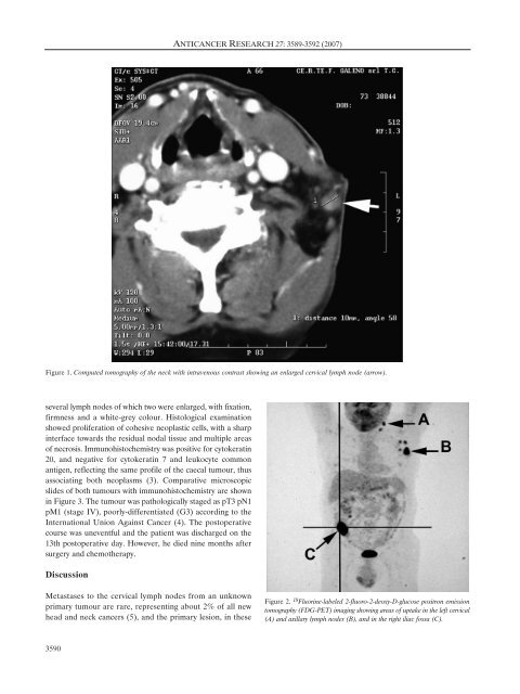 Cervical Node Metastasis as the First Sign of Cancer of the Caecum