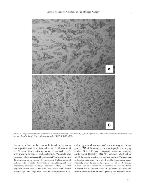 Cervical Node Metastasis as the First Sign of Cancer of the Caecum