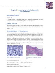 Chapter 8 Acute Lymphoblastic Leukemia and Lymphoma - Dako