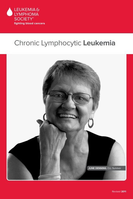 Chronic Lymphocytic Leukemia - The Leukemia & Lymphoma Society