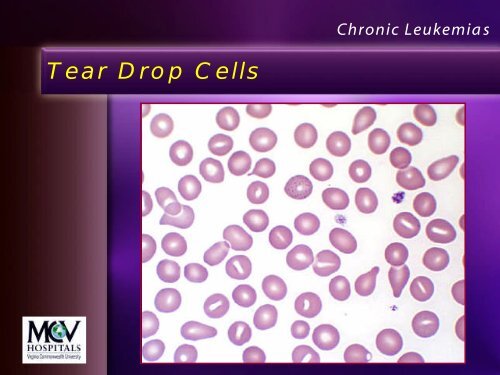 Leukemia Lecture Part 2 - Pathology