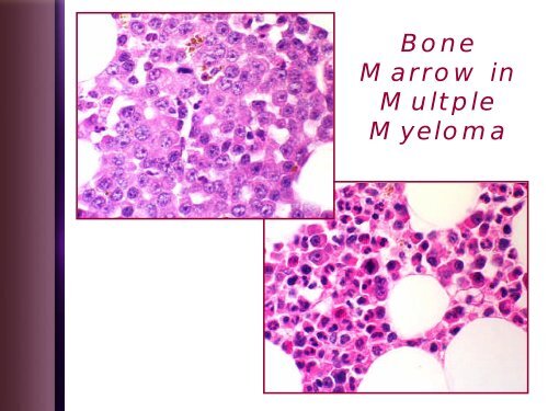 Leukemia Lecture Part 2 - Pathology