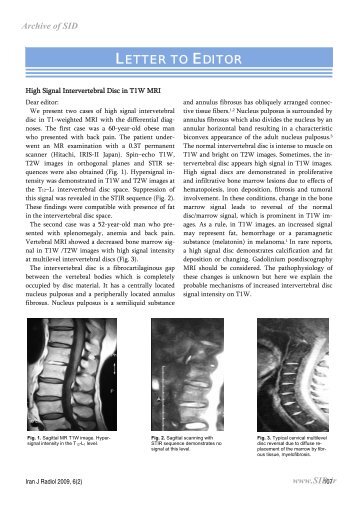 High Signal Intervertebral Disc in T1W MRI