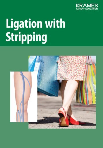 Ligation with Stripping - Veterans Health Library