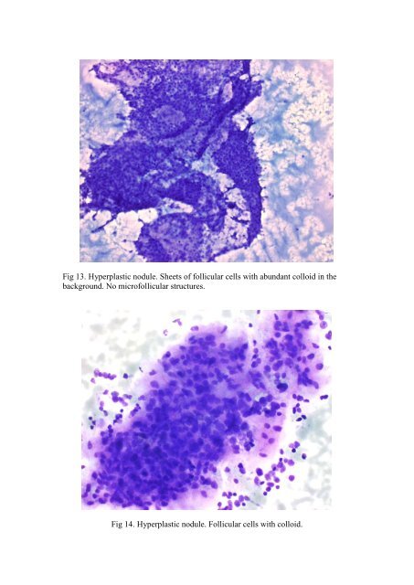 Thyroid cytology - RCPA