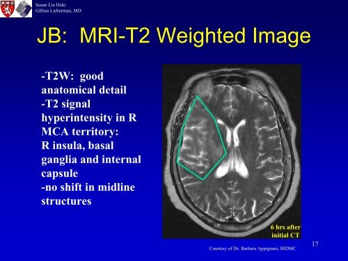 Diagnosis of Acute Ischemic Stroke