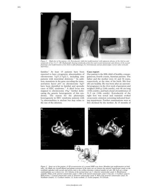 Split hand/split foot malformation associated with sensorineural ...