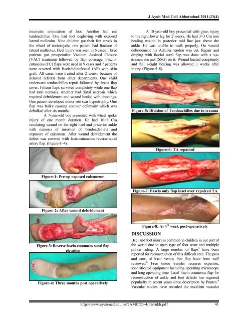 Distally based superficial Sural artery flap for foot - Ayub Medical ...