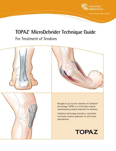 TOPAZ® MicroDebrider Technique Guide - ArthroCare Sports ...