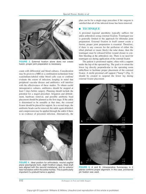 Ankle Arthrodesis Using Ring External Fixation - Orthofix.com