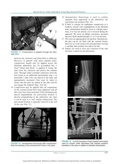 Ankle Arthrodesis Using Ring External Fixation - Orthofix.com