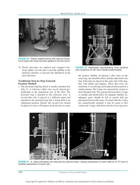 Ankle Arthrodesis Using Ring External Fixation - Orthofix.com